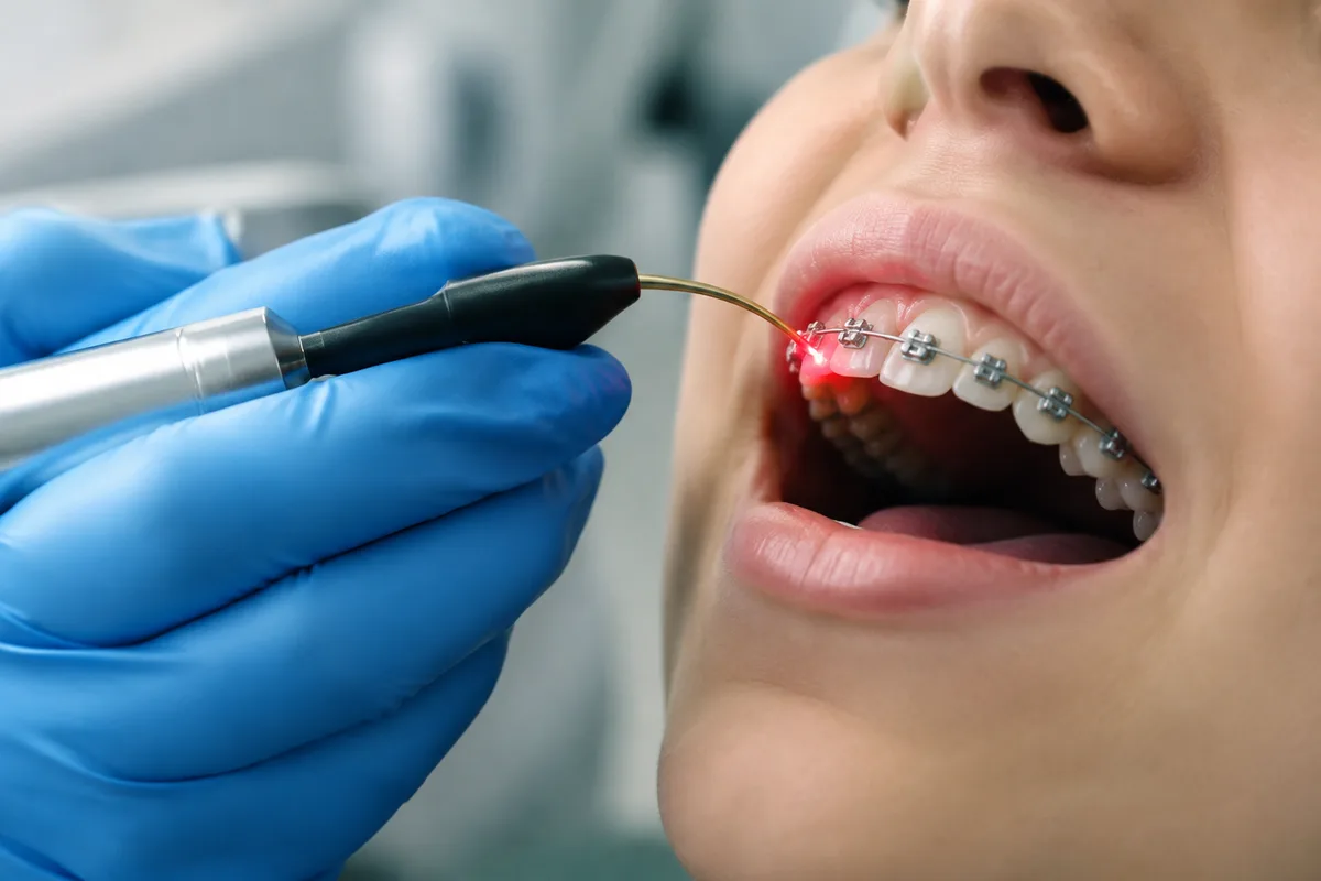 Soft Tissue Lasers