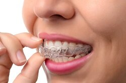 Holding clear teeth aligners in mouth Invisalign in Northvale, NJ and Manhattan, NY