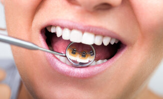 dental mirror in girl's mouth showing lingual braces on back of teeth. Orthodontics in Northvale, NJ
